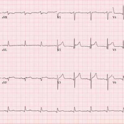 Snow Way to Take Care of Your Heart | Clinician Reviews