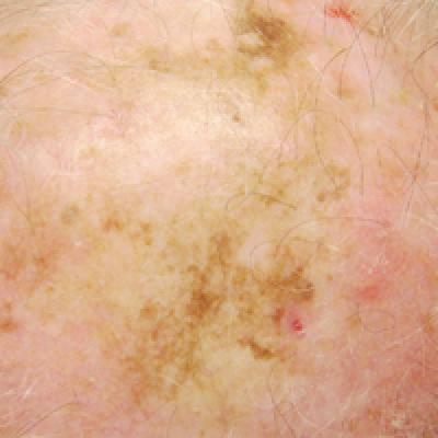 Topical Imiquimod Clears Invasive Melanoma | MDedge Dermatology