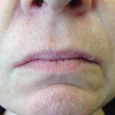 Current Concepts in Lip Augmentation | MDedge Dermatology