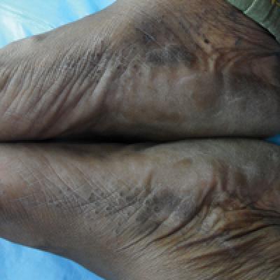 FOOT RASPING DAY! The other foot -- with EPPK Keratoderma Hyperkeratosis -  Jun 7, 2023 