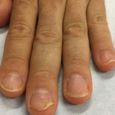Clinical Pearl: Early Diagnosis of Nail Psoriasis and Psoriatic Arthritis |  MDedge Dermatology