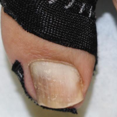 Clinical Pearl: Kinesiology Tape For Onychocryptosis | MDedge Dermatology