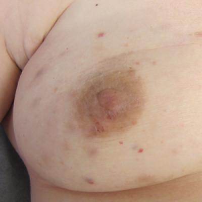 Multiple Atypical Vascular Lesions Following Breast-Conserving Surgery and  Radiation