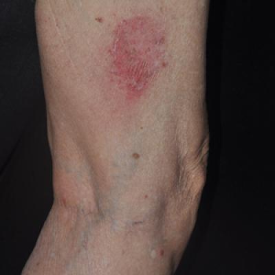 Psoriasiform Drug Eruption Secondary to Sorafenib: Case Series and ...