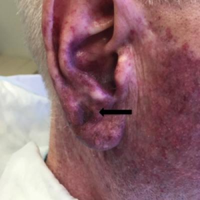 Melanoma In Situ Within a Port-Wine Stain | MDedge Dermatology