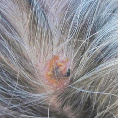 Cutaneous Metastases From Esophageal Adenocarcinoma on the Scalp ...