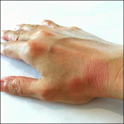 Emerging Therapies For Cutaneous Lupus Erythematosus | MDedge Dermatology