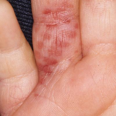 What’s Eating You? Megalopyge opercularis MDedge Dermatology