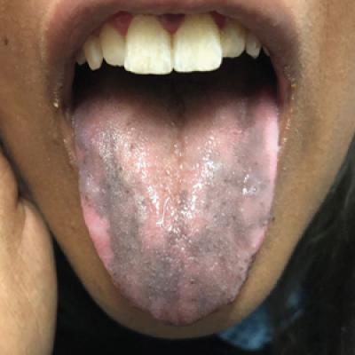 tongue mdedge hyperpigmentation pigmentation
