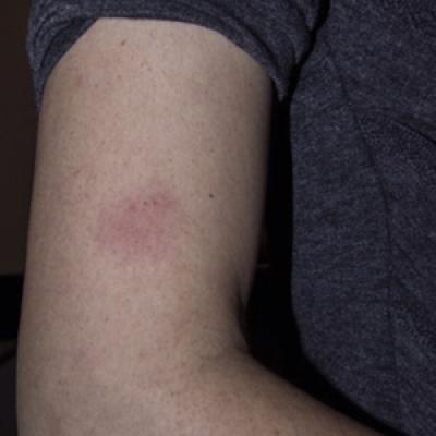 Cutaneous Filariasis in an American Traveler | MDedge Dermatology