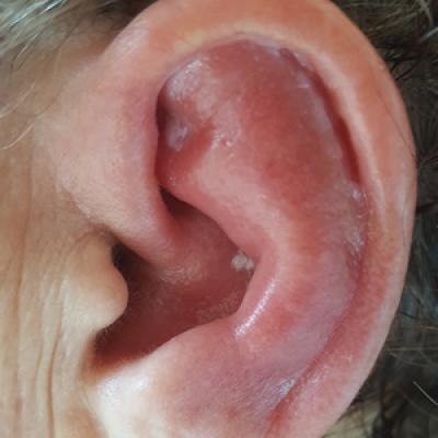 Oxide forseelser arbejdsløshed Red, Swollen, Tender Ear | MDedge Dermatology