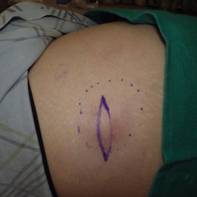 an unusual skin infection with achromobacter xylosoxidans mdedge dermatology an unusual skin infection with achromobacter xylosoxidans mdedge dermatology