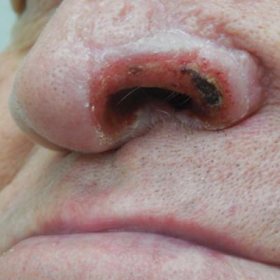 Unilateral Alar Ulceration | MDedge Dermatology