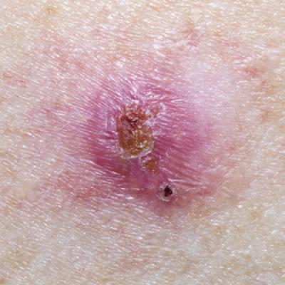 Reliability of Biopsy Margin Status for Basal Cell Carcinoma: A ...