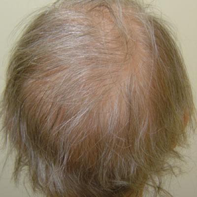 Permanent Alopecia in Breast Cancer Patients: Role of Taxanes and Endocrine  Therapies | MDedge Dermatology