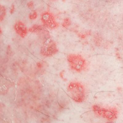 Tinea Incognito Mimicking Pustular Psoriasis in a Patient With ...