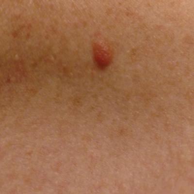 Desmoplastic Melanoma Masquerading as Neurofibroma | MDedge Dermatology