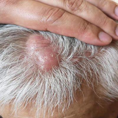 Agminated Nodules on the Scalp | MDedge Dermatology
