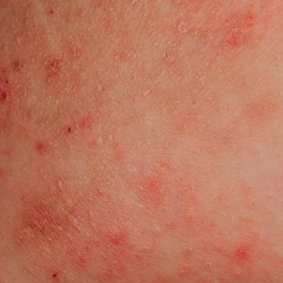 Atopic Dermatitis: Evolution And Revolution In Therapy 