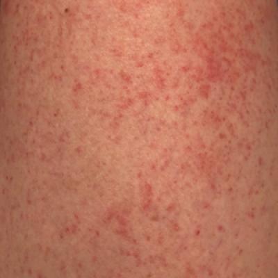 Autoeczematization: A Strange Id Reaction of the Skin | MDedge Dermatology