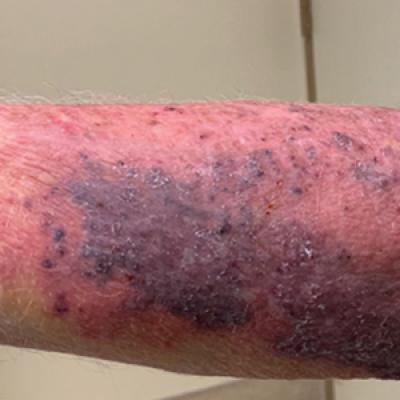 Mycetomalike Skin Infection Due to Gordonia bronchialis in an ...