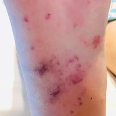 Nonspecific Skin Rash  Saint Luke's Health System