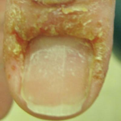 Green nail syndrome - Wikipedia