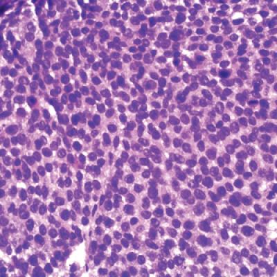 Aberrant expression of cd56 in metastatic malignant melanoma | mdedge