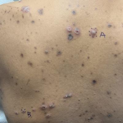 Keratotic Nodules in a Patient With End-Stage Renal Disease | MDedge ...