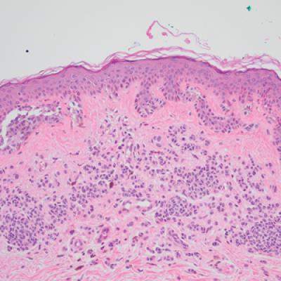 PRAME Expression in Melanocytic Proliferations in Special Sites ...