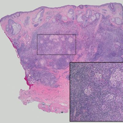 Tender Dermal Nodule on the Temple | MDedge Dermatology