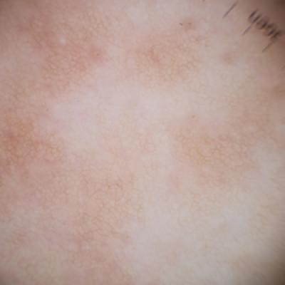 Eruptive Syringoma Manifesting as a Widespread Rash in 3 Patients ...