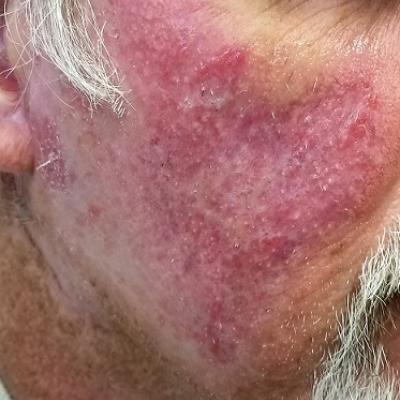 The Rash That Outlasts | Clinician Reviews