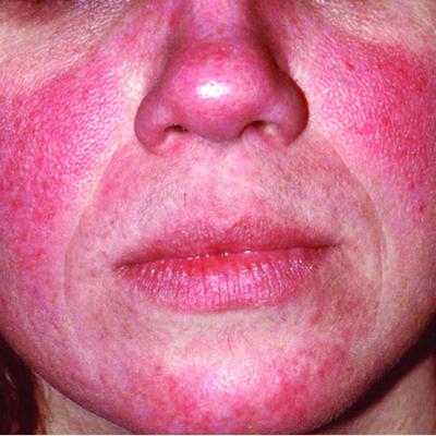 Rosacea tied to physical and psychological comorbidities | MDedge ...