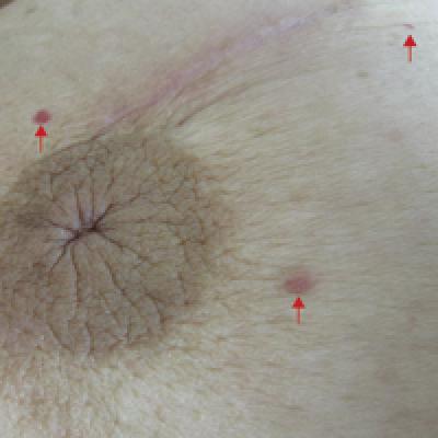 Multiple Primary Atypical Vascular Lesions Occurring In The Same Breast Mdedge Dermatology