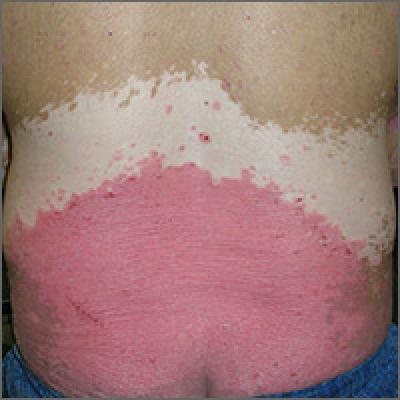 Rash and skin discoloration | MDedge Family Medicine