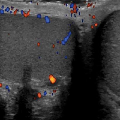 Emergency Imaging: Severe Left Testicular Swelling | MDedge Emergency ...