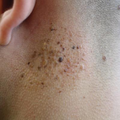 Agminated Heterogeneous Papules on the Neck | MDedge Dermatology