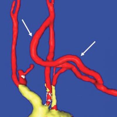 Carotid-axillary bypass for revascularization of the left subclavian ...