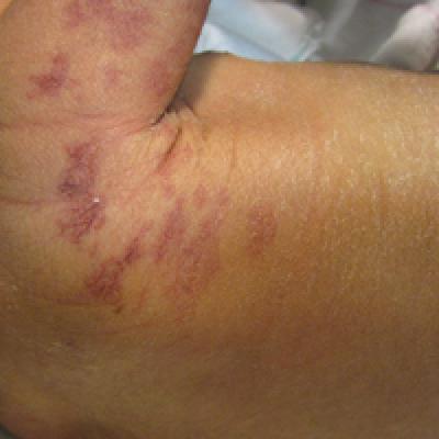 Red Patches on a Newborn | MDedge Dermatology