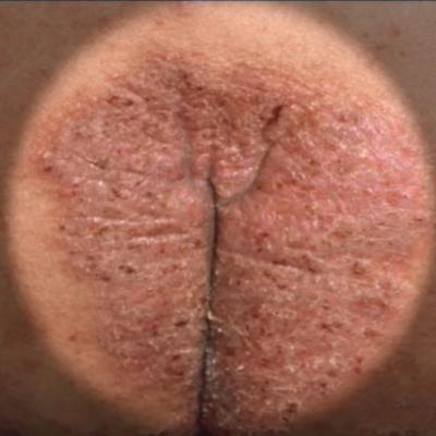 Female Genital Skin Conditions, Dermatology
