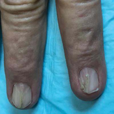 Nail-Patella Syndrome: Clinical Clues for Making the Diagnosis | MDedge  Dermatology
