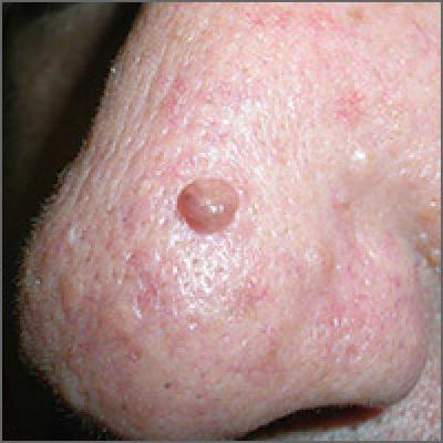 Hyperpigmented growth on nose | MDedge Family Medicine