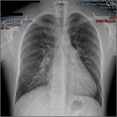 Mild cough • wheezing • loud heart sounds • Dx? | MDedge Family Medicine