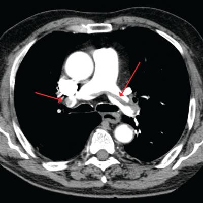 How to manage submassive pulmonary embolism | The Hospitalist