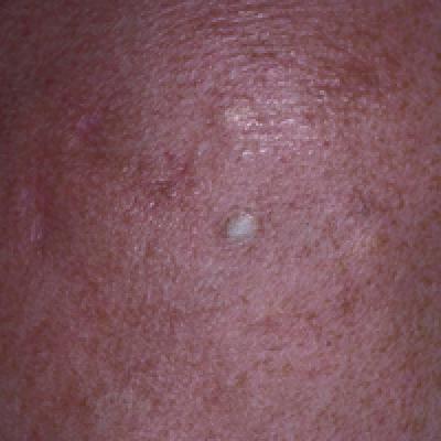 Co-occurrence of Steatocystoma Multiplex, Eruptive Vellus Hair Cysts, and  Trichofolliculomas | MDedge Dermatology