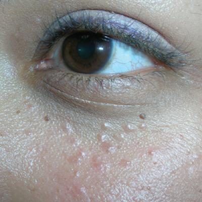 Thin Skin Under Eyes Causes Symptoms and Treatment