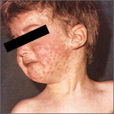 Measles: Why it’s still a threat | MDedge Family Medicine