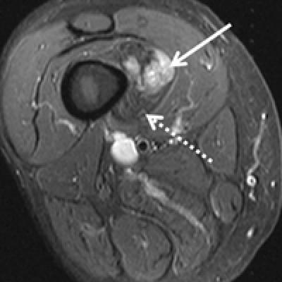 Rare Dual Lesion: Extraskeletal Osteosarcoma Developing Within a Simple ...