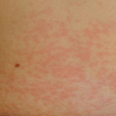 Delayed Cutaneous Reactions to Iodinated Contrast